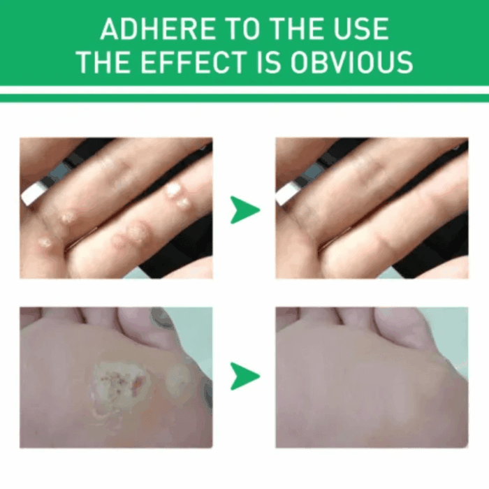 Jaysuing Active Corn Remover Serum 10ml - Image 3