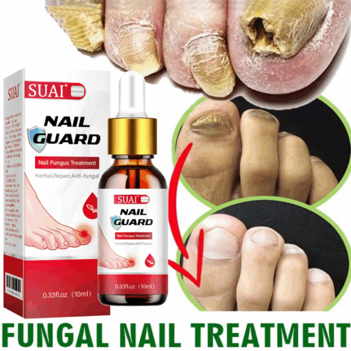 Jiaweishi Herbal Antibacterial Nail Solvent Serum 10Ml - Image 1